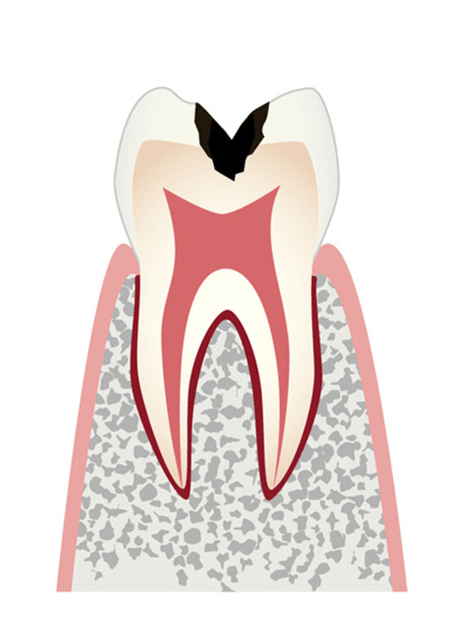 C2 歯の内部（象牙質）まで進行した虫歯