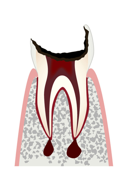 C4 歯根まで進行した虫歯